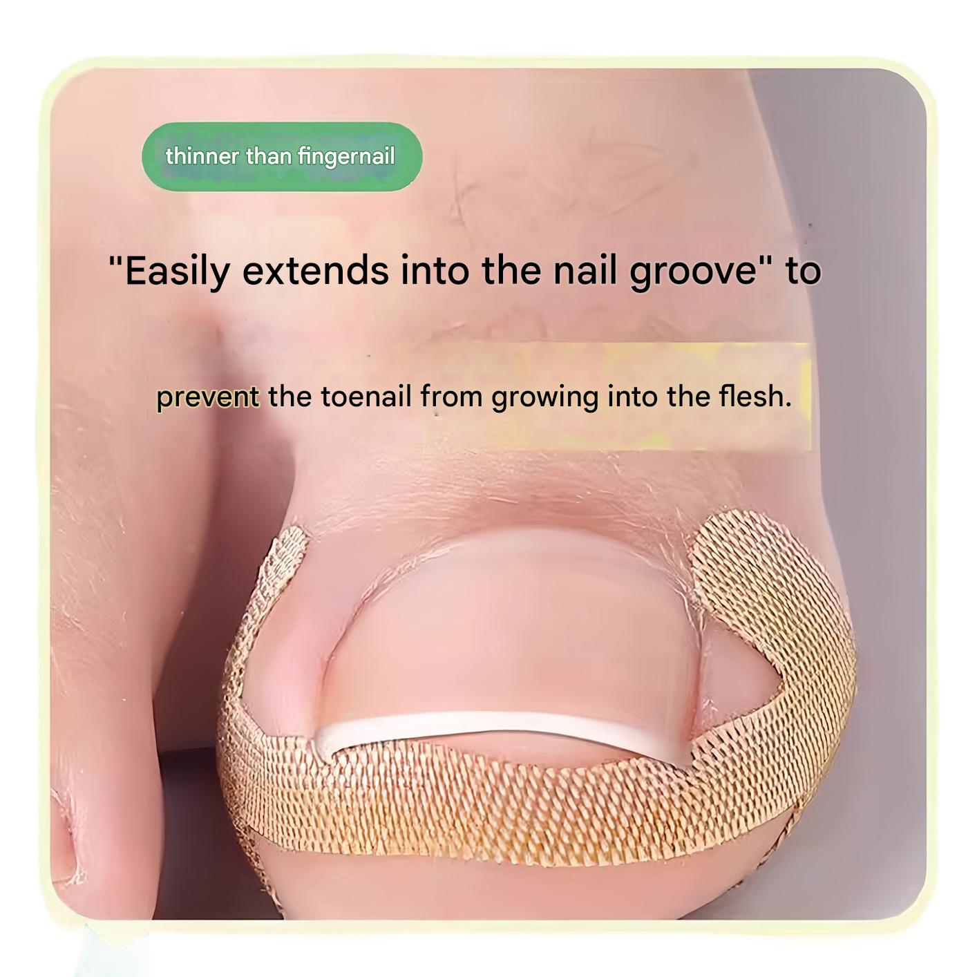 🔥🔥【Two Pieces Set】|  Ingrown Toenails Correction Patch & Nail groove air cushion