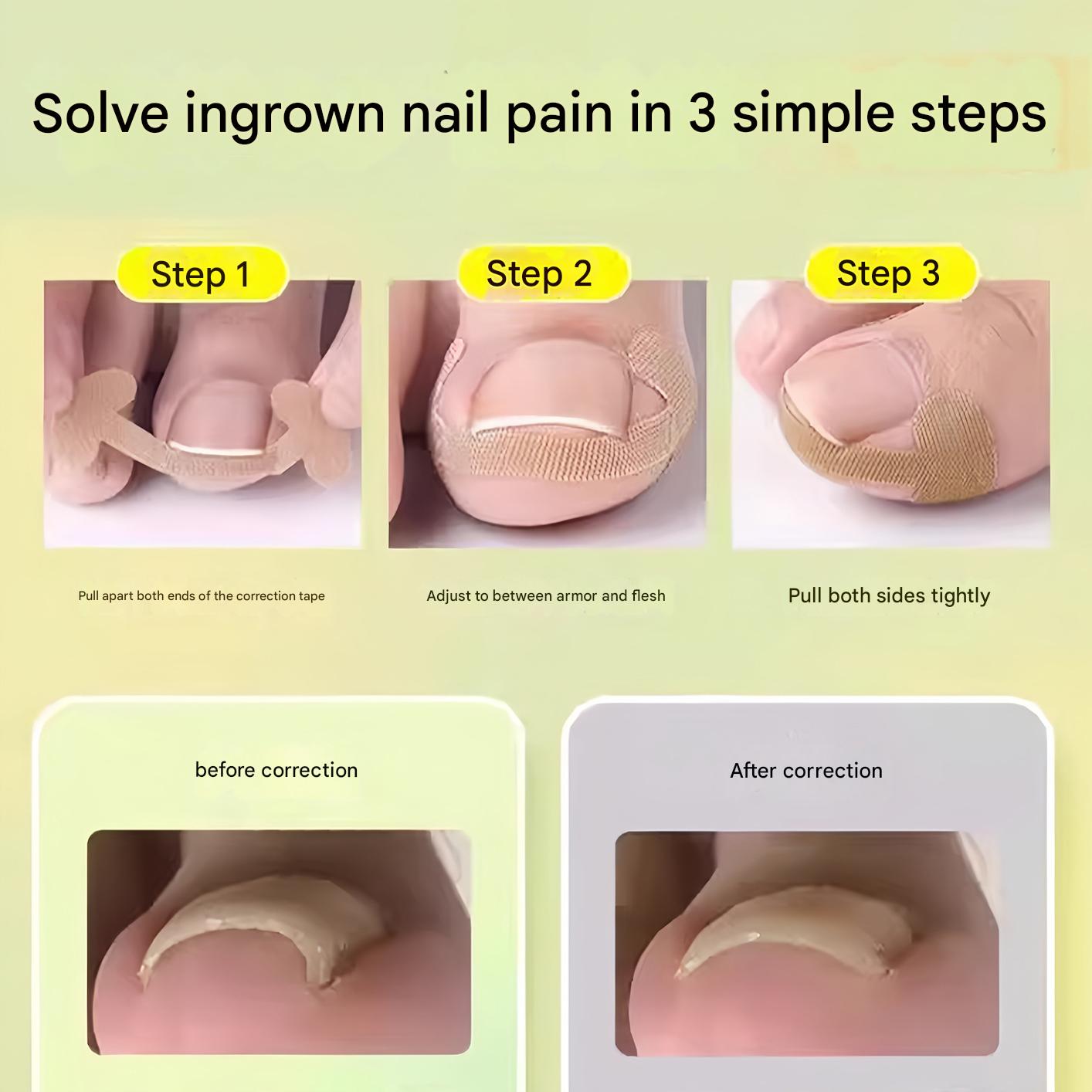 🔥🔥【Two Pieces Set】|  Ingrown Toenails Correction Patch & Nail groove air cushion