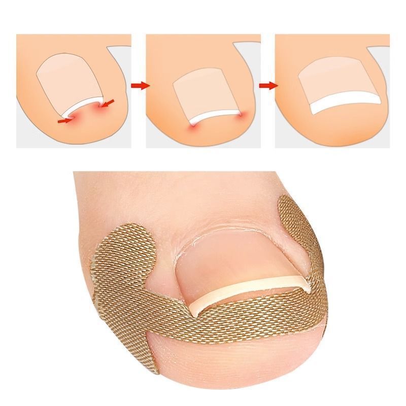 🔥🔥【Two Pieces Set】|  Ingrown Toenails Correction Patch & Nail groove air cushion