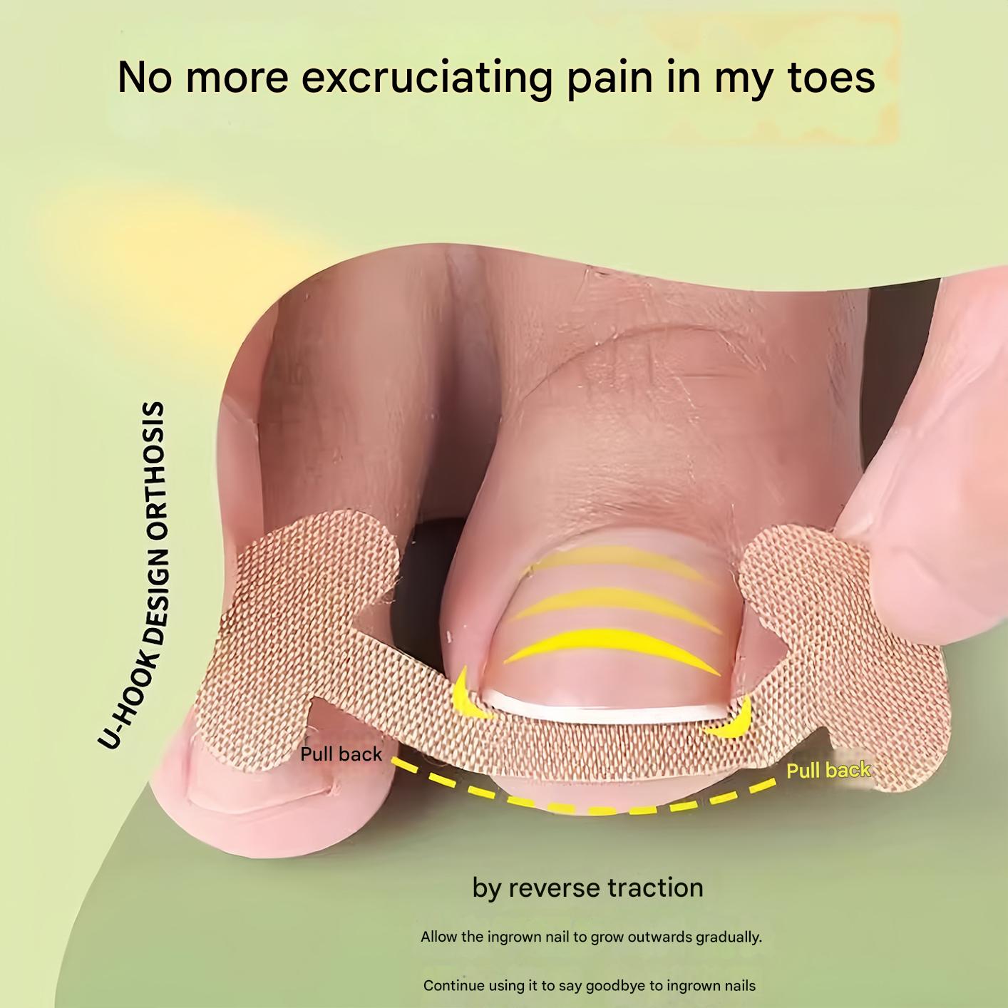 🔥🔥【Two Pieces Set】|  Ingrown Toenails Correction Patch & Nail groove air cushion